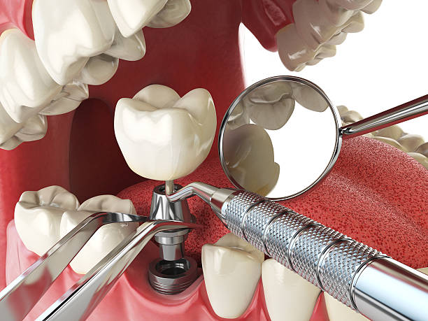 Best Emergency Dental Care for Broken or Chipped Teeth in Dunmore, PA